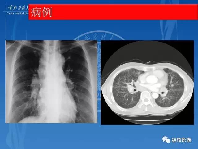 【PPT】肺肉芽肿病变的影像表现和病理基础