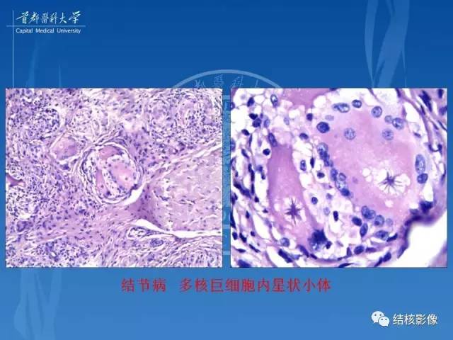 【PPT】肺肉芽肿病变的影像表现和病理基础