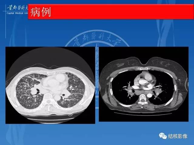 【PPT】肺肉芽肿病变的影像表现和病理基础
