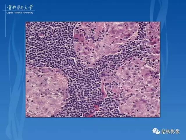 【PPT】肺肉芽肿病变的影像表现和病理基础