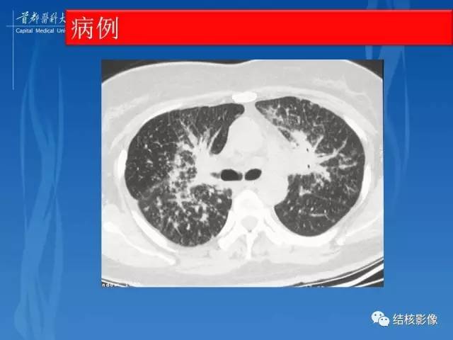 【PPT】肺肉芽肿病变的影像表现和病理基础