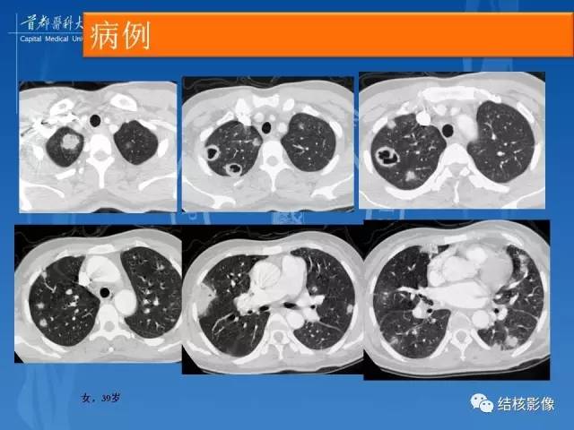 【PPT】肺肉芽肿病变的影像表现和病理基础