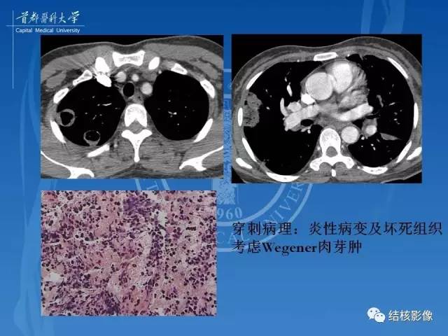 【PPT】肺肉芽肿病变的影像表现和病理基础