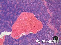 手把手教你会读片:胰腺实性假乳头状瘤 手把手教你会读片:胰腺实性假乳头状瘤