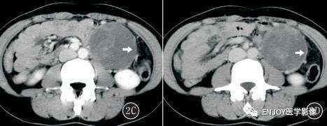 手把手教你会读片:胰腺实性假乳头状瘤 手把手教你会读片:胰腺实性假乳头状瘤