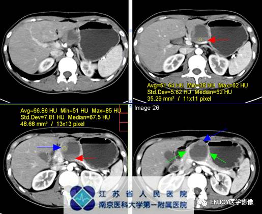 手把手教你会读片:胰腺实性假乳头状瘤 手把手教你会读片:胰腺实性假乳头状瘤