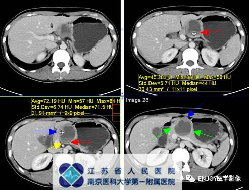 手把手教你会读片:胰腺实性假乳头状瘤 手把手教你会读片:胰腺实性假乳头状瘤
