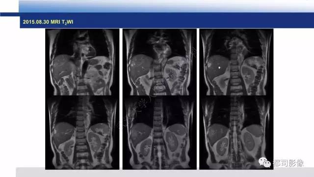 【PPT】肝脏血管肉瘤影像诊断