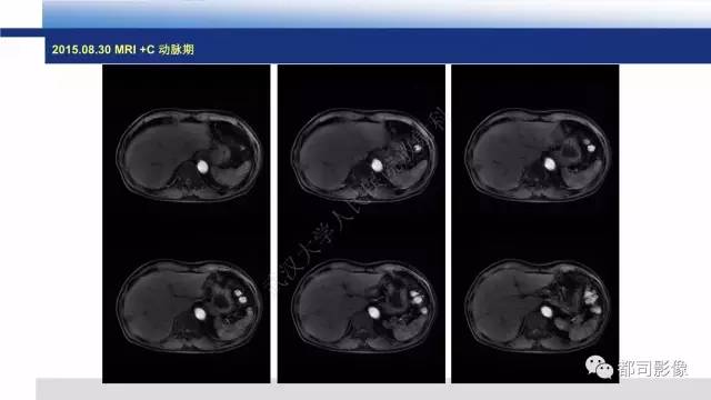 【PPT】肝脏血管肉瘤影像诊断