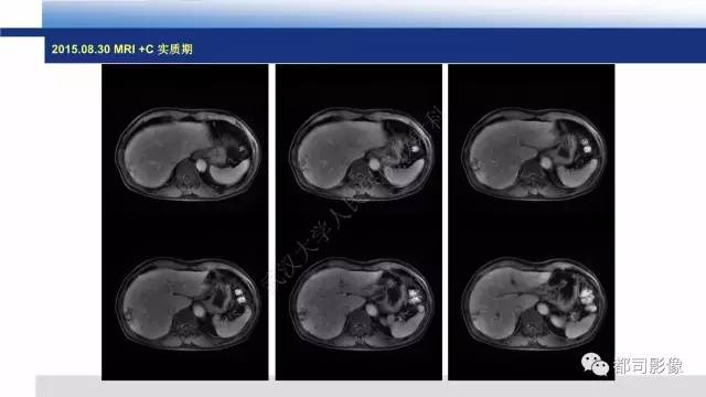 【PPT】肝脏血管肉瘤影像诊断