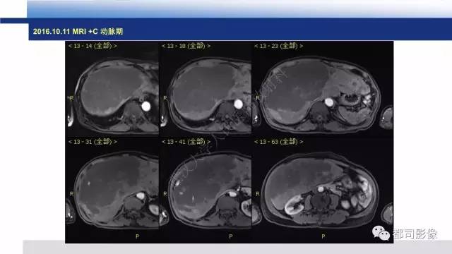 【PPT】肝脏血管肉瘤影像诊断