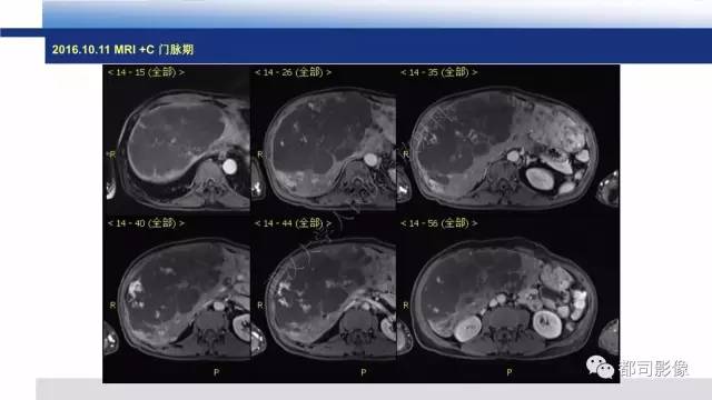 【PPT】肝脏血管肉瘤影像诊断