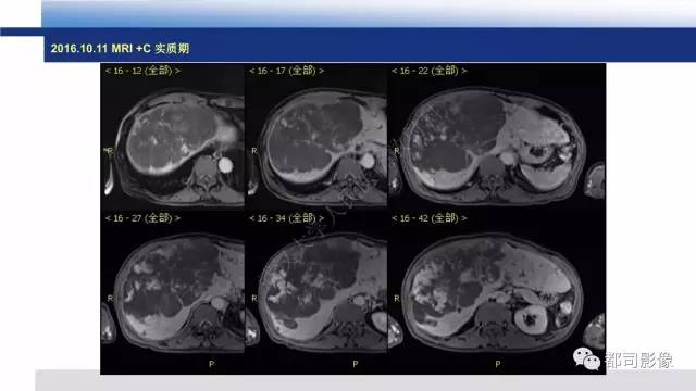 【PPT】肝脏血管肉瘤影像诊断
