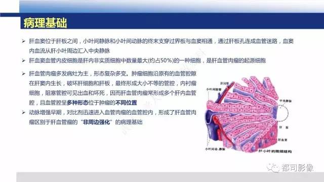 【PPT】肝脏血管肉瘤影像诊断
