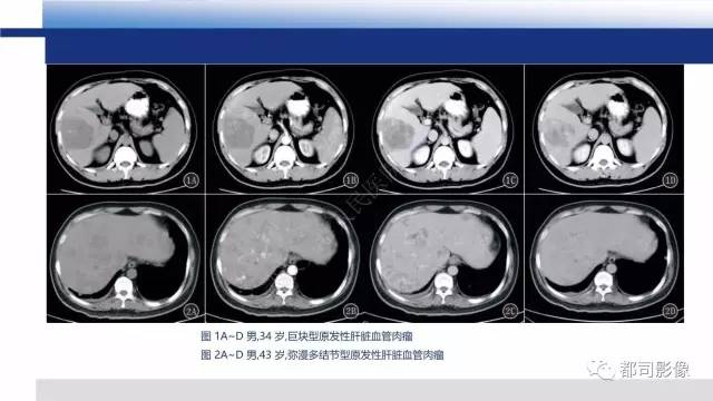 【PPT】肝脏血管肉瘤影像诊断