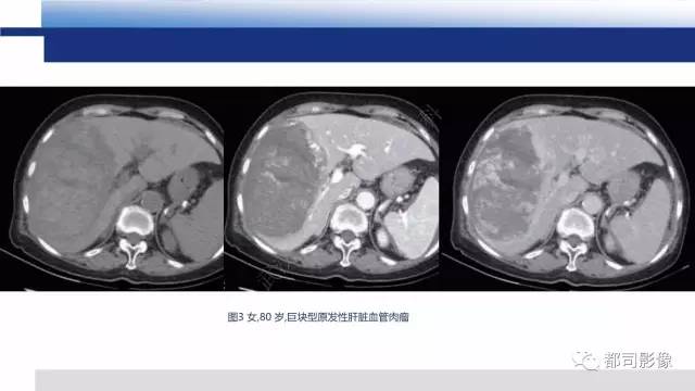 【PPT】肝脏血管肉瘤影像诊断