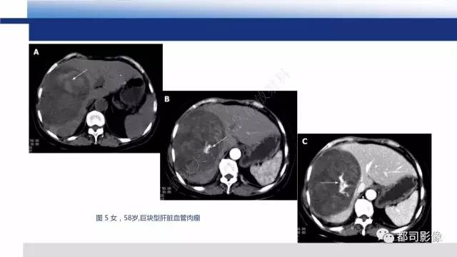 【PPT】肝脏血管肉瘤影像诊断