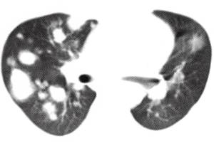 【病例】肺烟曲霉菌病1例CT影像解析 【病例】肺烟曲霉菌病1例CT影像解析