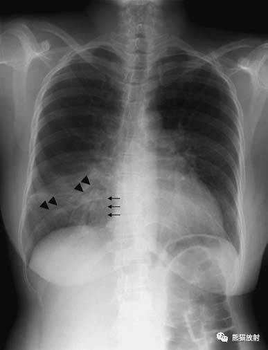 【急诊】肺炎、COPD、肺水肿、心脏扩大、气胸(胸部X线平片)