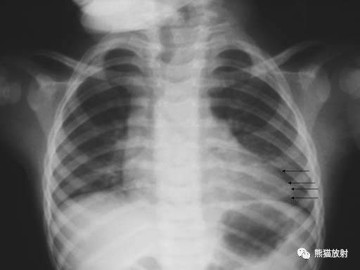 【急诊】肺炎、COPD、肺水肿、心脏扩大、气胸(胸部X线平片)