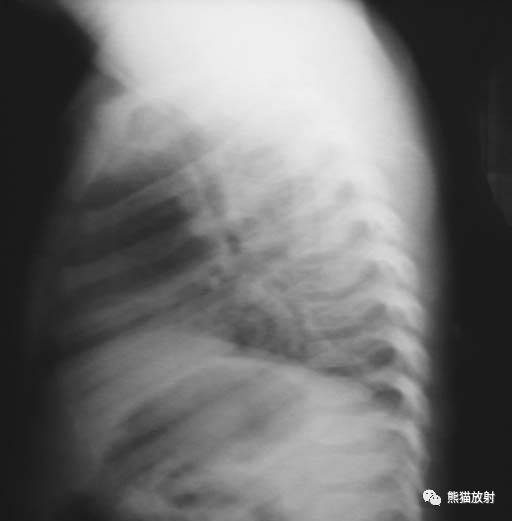 【急诊】肺炎、COPD、肺水肿、心脏扩大、气胸(胸部X线平片)