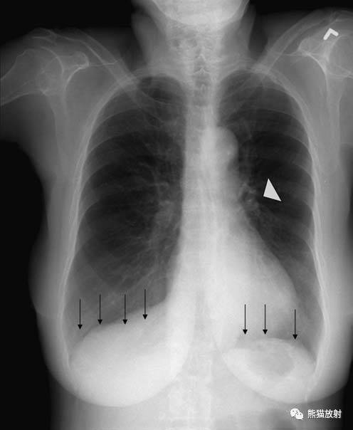 【急诊】肺炎、COPD、肺水肿、心脏扩大、气胸(胸部X线平片)
