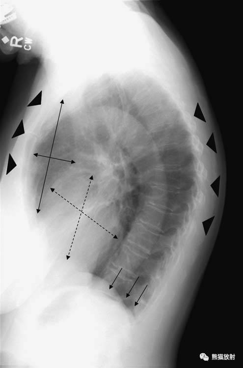 【急诊】肺炎、COPD、肺水肿、心脏扩大、气胸(胸部X线平片)