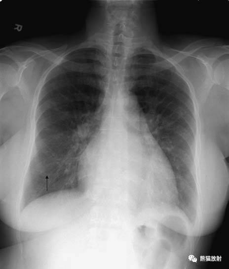 【急诊】肺炎、COPD、肺水肿、心脏扩大、气胸(胸部X线平片)
