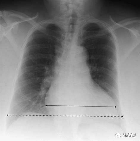【急诊】肺炎、COPD、肺水肿、心脏扩大、气胸(胸部X线平片)