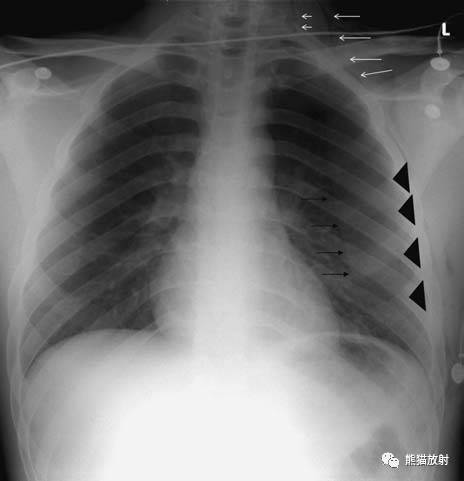 【急诊】肺炎、COPD、肺水肿、心脏扩大、气胸(胸部X线平片)