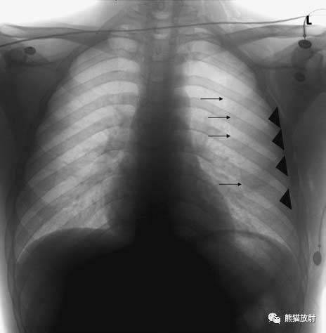 【急诊】肺炎、COPD、肺水肿、心脏扩大、气胸(胸部X线平片)