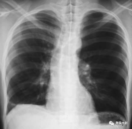 【急诊】肺炎、COPD、肺水肿、心脏扩大、气胸(胸部X线平片)