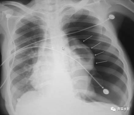 【急诊】肺炎、COPD、肺水肿、心脏扩大、气胸(胸部X线平片)