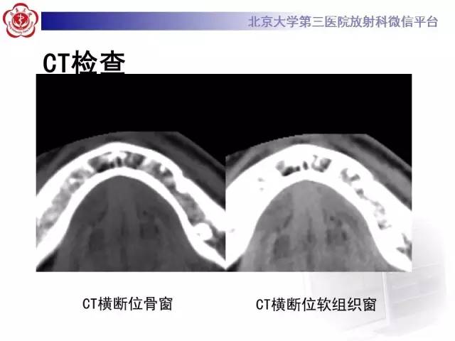 【病例】C2椎体脊索瘤1例CT及MR影像表现