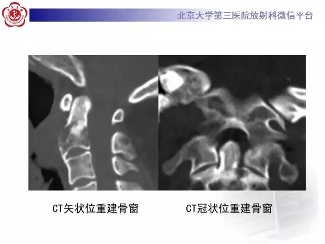 【病例】C2椎体脊索瘤1例CT及MR影像表现