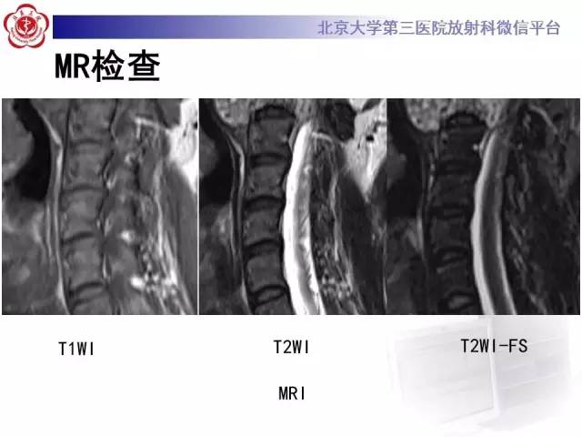 【病例】C2椎体脊索瘤1例CT及MR影像表现