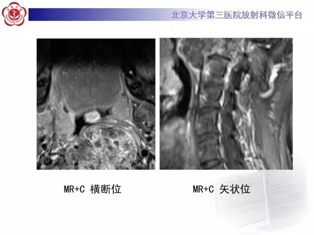 【病例】C2椎体脊索瘤1例CT及MR影像表现