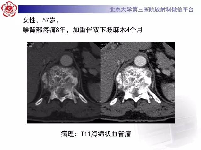 【病例】C2椎体脊索瘤1例CT及MR影像表现