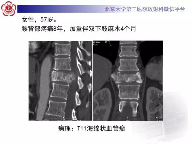 【病例】C2椎体脊索瘤1例CT及MR影像表现