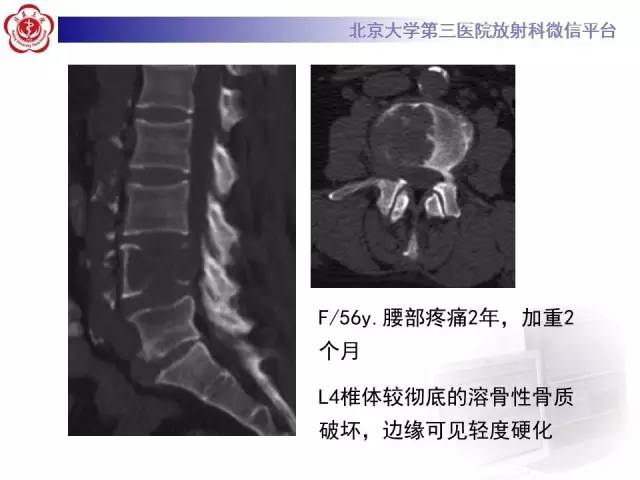 【病例】C2椎体脊索瘤1例CT及MR影像表现