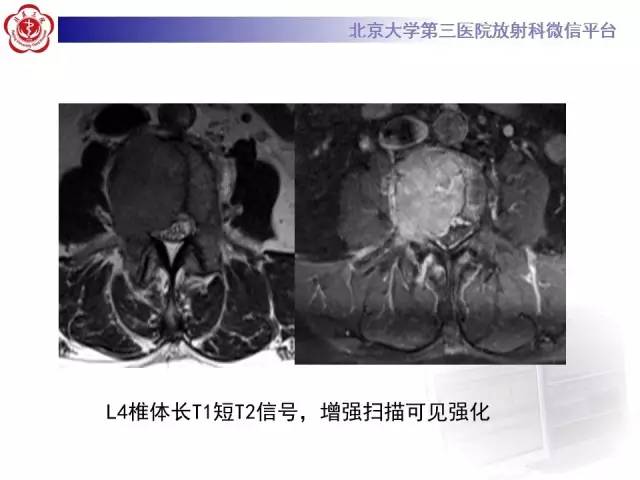 【病例】C2椎体脊索瘤1例CT及MR影像表现