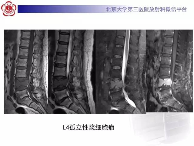 【病例】C2椎体脊索瘤1例CT及MR影像表现