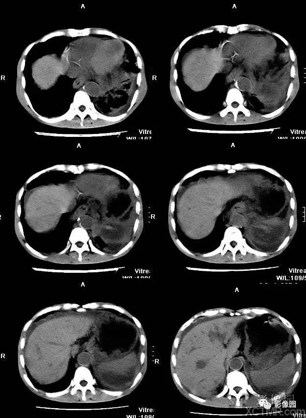 【病例】胰腺假性囊肿并囊内假性动脉瘤形成1例CT 【病例】胰腺假性囊肿并囊内假性动脉瘤形成1例CT