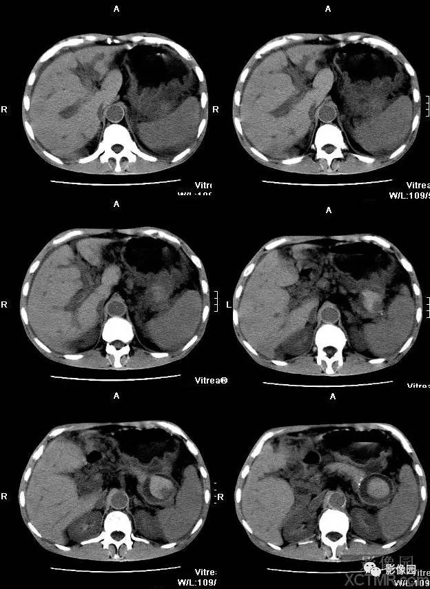 【病例】胰腺假性囊肿并囊内假性动脉瘤形成1例CT 【病例】胰腺假性囊肿并囊内假性动脉瘤形成1例CT