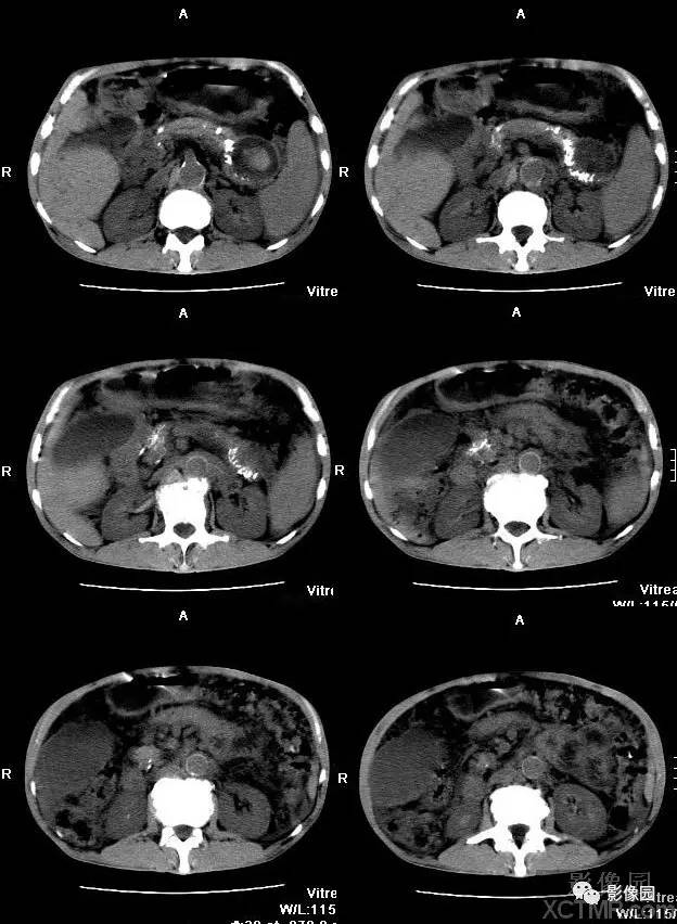 【病例】胰腺假性囊肿并囊内假性动脉瘤形成1例CT 【病例】胰腺假性囊肿并囊内假性动脉瘤形成1例CT
