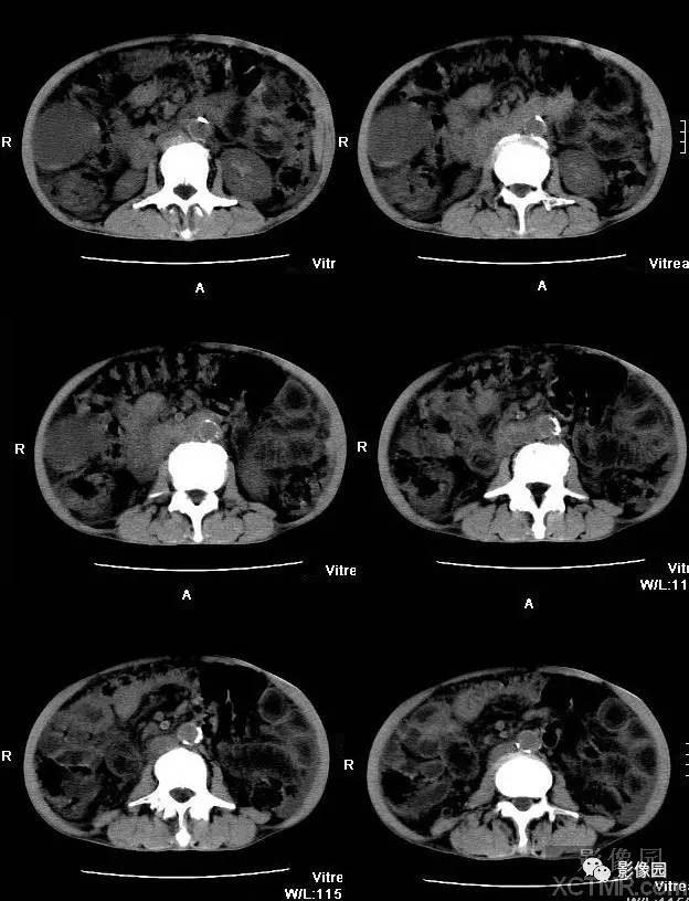 【病例】胰腺假性囊肿并囊内假性动脉瘤形成1例CT 【病例】胰腺假性囊肿并囊内假性动脉瘤形成1例CT