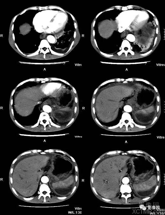 【病例】胰腺假性囊肿并囊内假性动脉瘤形成1例CT 【病例】胰腺假性囊肿并囊内假性动脉瘤形成1例CT