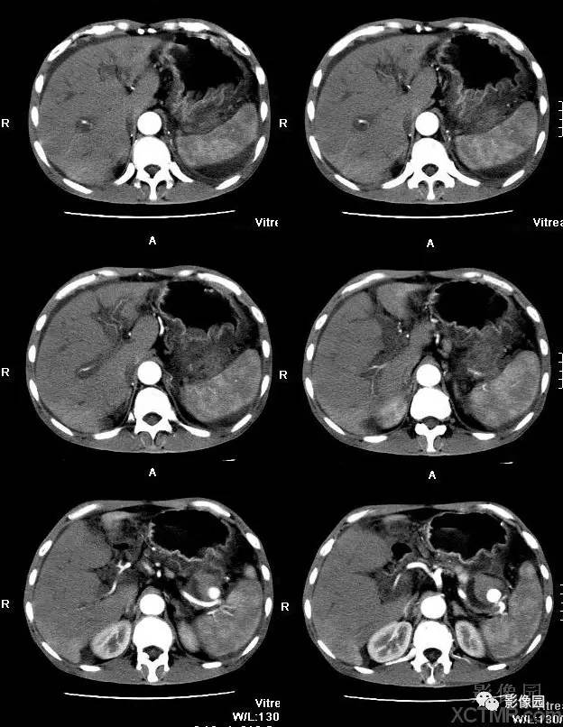 【病例】胰腺假性囊肿并囊内假性动脉瘤形成1例CT 【病例】胰腺假性囊肿并囊内假性动脉瘤形成1例CT