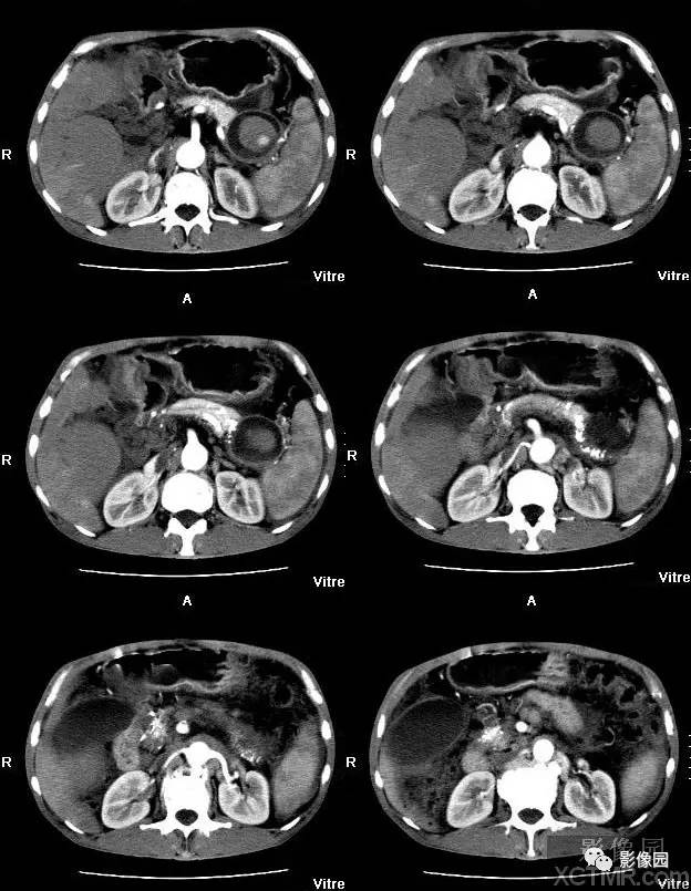 【病例】胰腺假性囊肿并囊内假性动脉瘤形成1例CT 【病例】胰腺假性囊肿并囊内假性动脉瘤形成1例CT