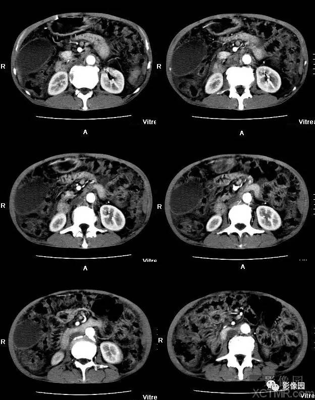 【病例】胰腺假性囊肿并囊内假性动脉瘤形成1例CT 【病例】胰腺假性囊肿并囊内假性动脉瘤形成1例CT
